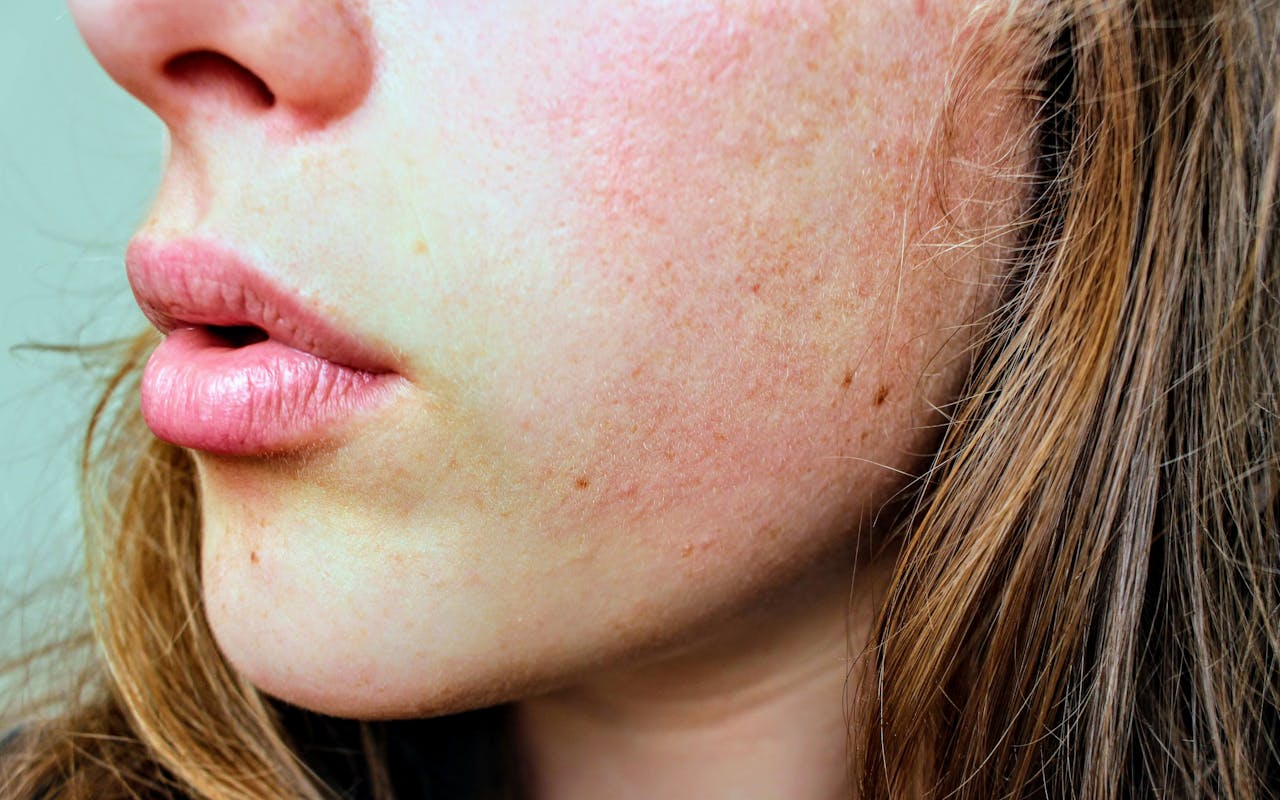 What Does A Vape Rash Look Like? What Does A Vape Rash Look Like?